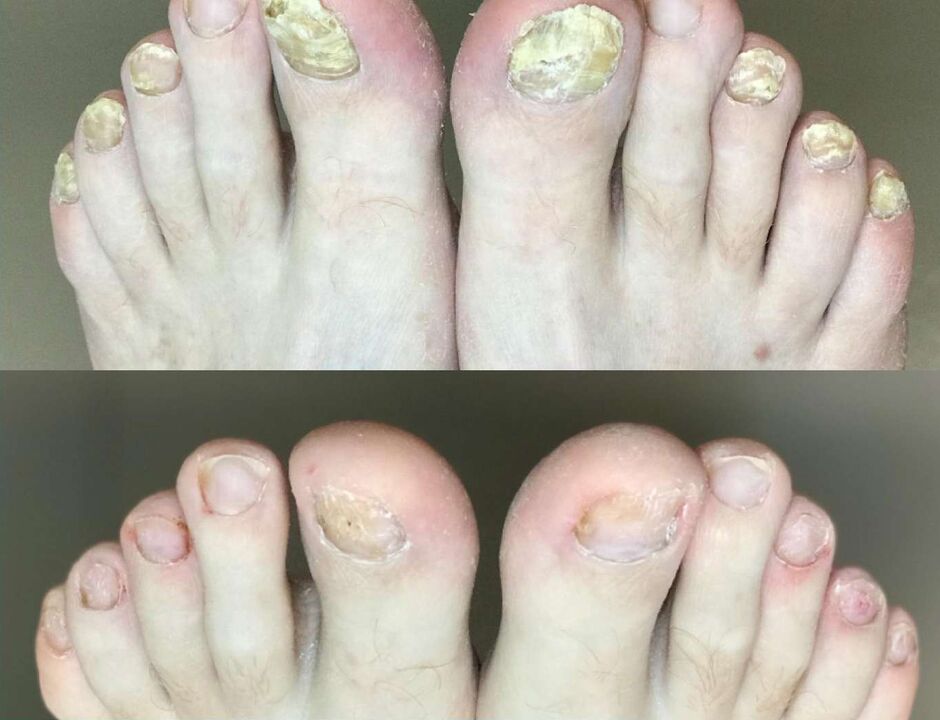 Vor und nach der Behandlung versprach Pilgus Creme