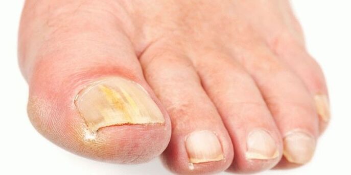 Effektive Nagelpilzprodukte
