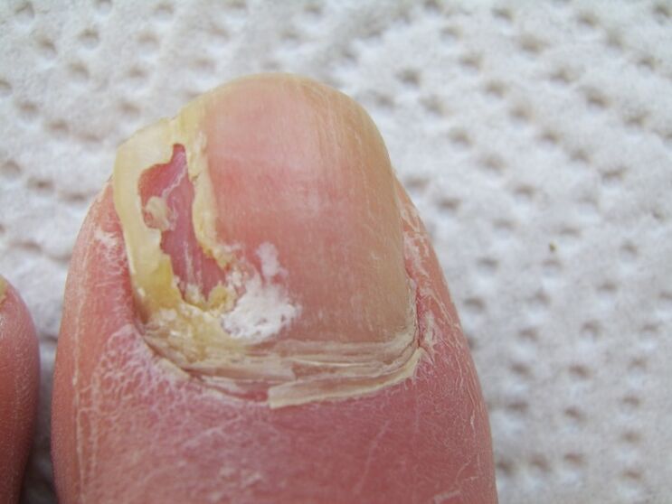 Bei der Onychomykose kommt es zu einer Verformung der Nagelplatte.