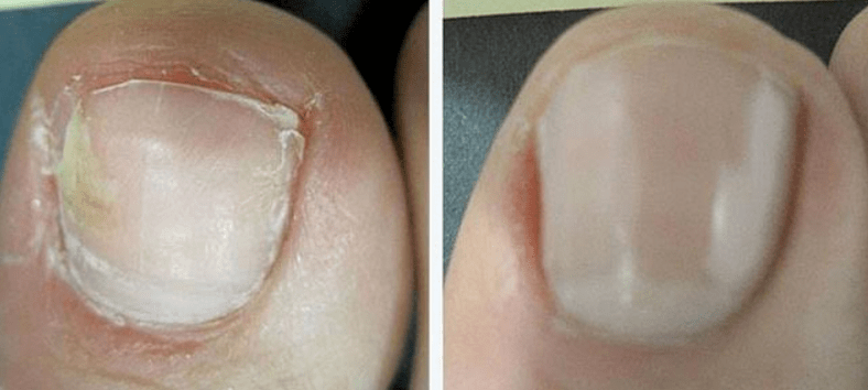 Nägel vor und nach einer Pilzbehandlung.