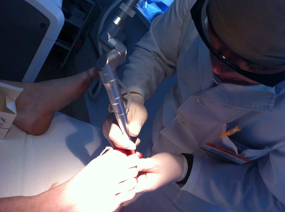 Laserbehandlung von Mykose